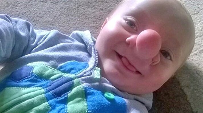 Ensefalosel isimli hastalıkla doğan bu bebeğin beyin dokusu kafasındaki açıklıktan ötürü burnunda büyüyor.