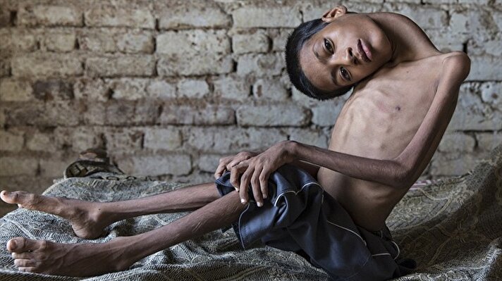 Konjenital miyopati (birbirinden bağımsız bazı yapısal kas değişiklikleri ile kendilerini gösteren bir grup kas hastalığı) hastalığı olan 13 yaşındaki Mahendra Ahirwar'in boynu 180 derece eğri. 