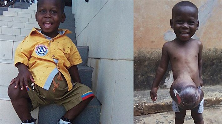 Gana'da yaşayan 3 yaşındaki Ethan Sugloo milyonda bir görülen bir hastalıkla dünyaya geldi.