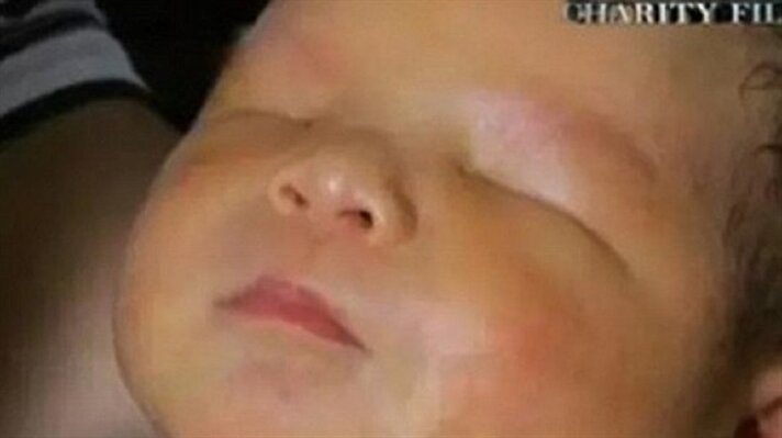 Çin'de küçük bir bebek gözleri olmadan doğdu. Anoftalmi olarak adlandırılan ve her 10 binde 30 görülen sendromda bebekler göz dokusu ya hiç olmadan ya da çok az dokuyla dünyaya geliyor. Bu nedenle hayatı boyunca asla göremeyecek.