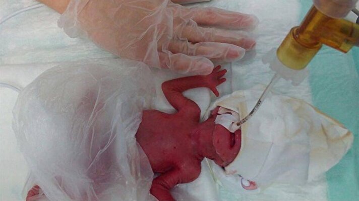Bilecik'te oturan İngilizce öğretmeni 30 yaşındaki Ayşe Esra Ay, geçen yıl 16 Kasım'da Eskişehir'de özel bir hastanede erken doğum sonucunda sezaryenle 27 santimetre boyunda, 380 gram ağırlığında bir kız bebek dünyaya getirdi. 