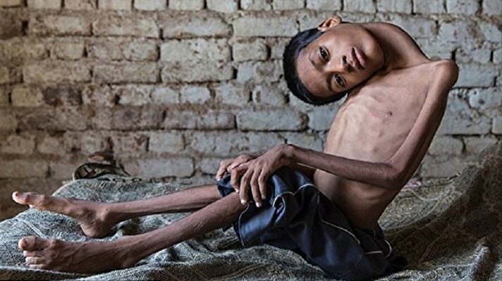 12 yaşındaki Hintli çocuğun halini görenler şaşkınlık içinde kaldı. Başı normal insanlarınkine göre neredeyse 180 derece ters şekilde doğan Mahendra Ahirwar zorlu bir hayat yaşadı.
