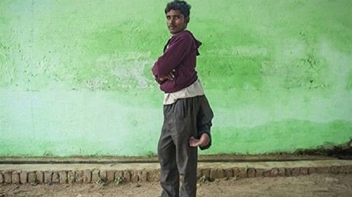Hindistan'da 4 bacaklı olarak dünyaya gelen 20 yaşındaki Arun Rajput isimli genç bu rahatsızlığından dolayı yaşadığı köy halkı tarafından dışlandı.