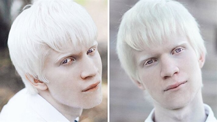 Albino deride, saçlarda ve gözlerde normal rengini veren boya maddesinin irsi olarak yokluğu bir metabolizma hastalığıdır​.