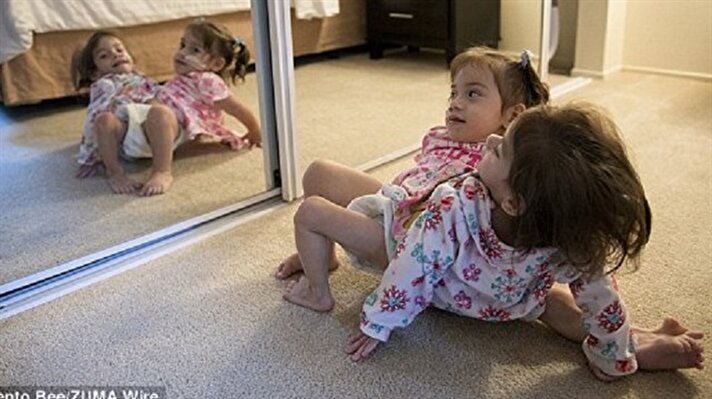 Eva ve Erika Sandoval isimli 2 yaşındaki yapışık ikizler başarılı bir operasyonla birbirlerinden ayrıldı. 
