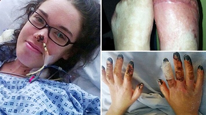 İngiltere'de yaşayan 21 yaşındaki Sophie Royce, Menenjitin W tipi virüsü ile ölümden döndü

