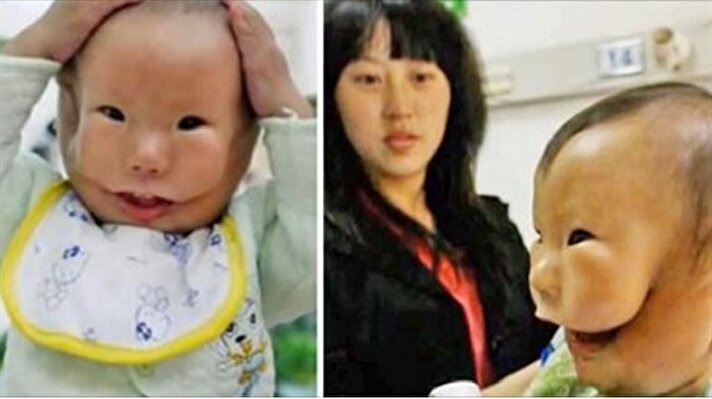 Doktorlar doğumdan sonra bebeğin yüzünü gördüklerinde şaşkınlıklarını gizleyemedi. Kangkang isimli bebek doğduğunda çok farklı görünüyordu ve ebeler, annenin bebeğini başta görmesine izin vermedi.