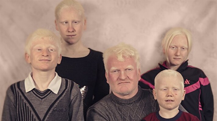 Türkiye'nin 'beyaz melekleri' albinolar