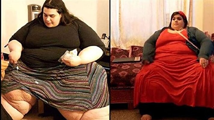 Amber Rachdi who lives in the U.S.’s Oregon, was diagnosed with obesity and reached 292 kilograms (643 pounds) at an extremely young age.