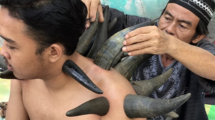 Endonezyalılar geleneksel tedavi yöntemlerinden kupa çekmeyi güç sembolü olduğuna inanılan bufalo boynuzlarıyla yaptırıyor.

