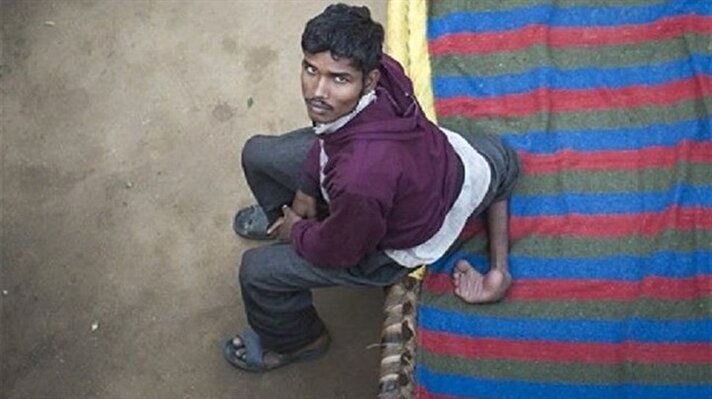 Hindistan'da 4 bacaklı olarak dünyaya gelen 20 yaşındaki Arun Rajput isimli genç bu rahatsızlığından dolayı yaşadığı köy halkı tarafından dışlandı.
