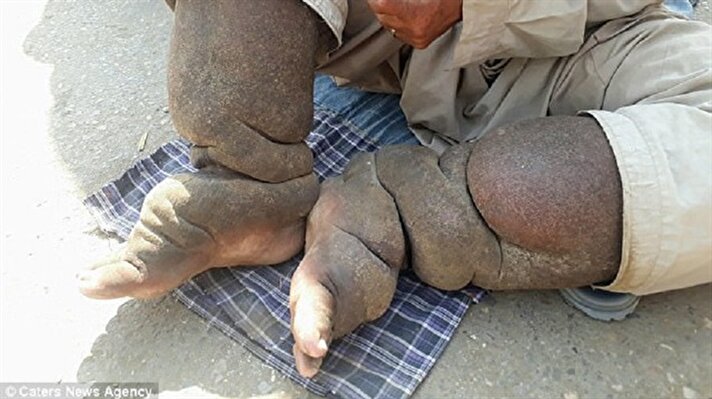 Pakistan'ın Kaçari şehrinde yaşayan 53 yaşındaki Muhammed Saleem, 17 senedir fil adam hastalığı ile mücadele ediyor. 