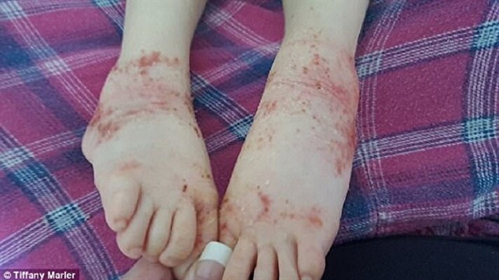 Birçok yiyeceğe alerjisi olan 3 yaşındaki Gabby Marler aynı zamanda aşırı hassas bir cilde sahip. Egzamayla da mücadele etmeye çalışan küçük kız günlük hayat içerisinde çok zorlanıyor. 