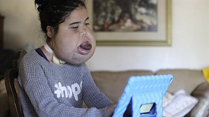 Doğduğunda yüzünde ender görülen bir tümör olan Jacqueline Rodriguez şimdi 16 yaşında. 
