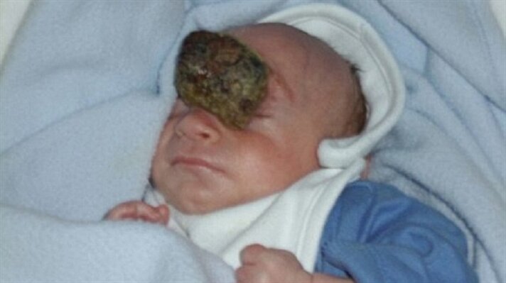 İngiltere'de 11 Haziran 2008'de dünyaya gelen Jamie Daniel, bütün doktorları hayret içinde bıraktı. Beyni dışarıda dünyaya gelen bebek için doktorların umudu yoktu. 