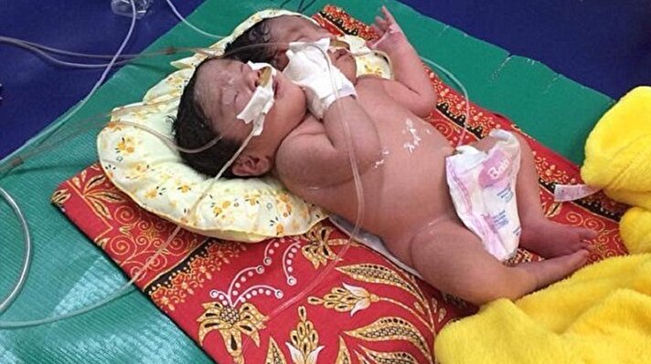 Kamboçya'nın kuzeybatısında kalan Siem Reap şehrinde yaşayan 35 yaşındaki Ket Mary, yeterli imkanları olmamasından dolayı hamilelik sırasında yaptırması gereken testleri yaptıramadığı için bebekteki tehlikeden habersizdi. 
