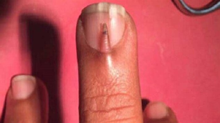 Pakistan'ın Bahavalpur şehrinde yaşanan olayda doktorlar şaştı kaldı. 28 yaşındaki adam tırnağının üzerinde büyümekte olan parmağın ağrısından şikayetçiydi. 
