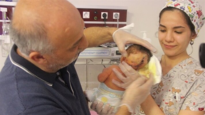 Suriye’nin Halep şehrinde yaşayan ve 7’inci çocuğu Abdullatif Şekrak’a hamile olan Suriyeli Sana Hilel sancısının artması ve riskli doğum olduğu için Türkiye’de Hatay’da Mustafa Kemal Üniversitesi Araştırma ve Uygulama Hastanesi’nde sezaryen ile doğum yaptı. Çift başlı bir çocuğu dünyaya gelen Suriyeli Firas Şekrak ile Sana Hilel çiftine bebeğin riskli olduğu için hemen ameliyat edilmesi gerektiği söylendi. Suriyeli çift Halep’ten gelerek Türkiye’de doğan minik bebeklerini hemen İskenderun’da bulunan özel bir hastaneye getirdi.
