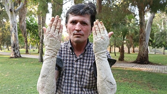 Musa Sümbül has suffered from psoriasis for over two decades. He is seeking a cure so he can return to normal life, work and start a family.

