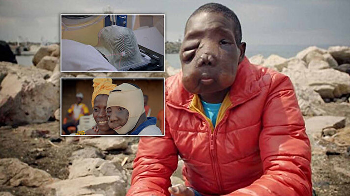 Fildişi Sahili'nde yaşayan Kambou Sie, kötü huylu kitle tespit edildiğinde 10 yaşındaydı. 