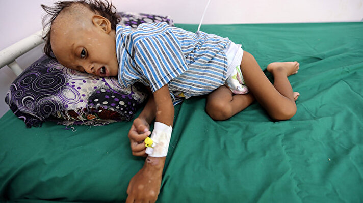 Dünyanın en feci insanlık felaketlerinden birinin yaşandığı Yemen'de, nüfusun yaklaşık dörtte üçüne tekabül eden 22 milyon insan, acil insani yardım ve korumaya muhtaç. Birleşmiş Milletler, her 10 dakikada 5 yaş altı bir çocuk önlenebilir bir ölüme kurban gittiğini ifade ediyor. BM İnsan Hakları Ofisi'nin 2017 yılındaki açıklamasına göre, en az 10 bin insan can verdi.