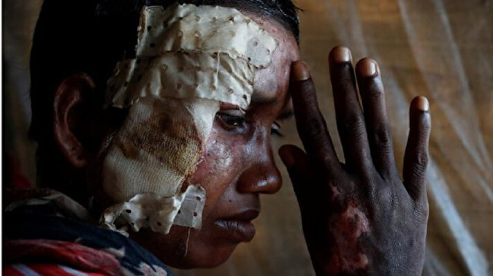 Myanmar ordusu Arakanlı Müslümanların köylerini yakmak ve yüz binlerce Arakanlıyı Bangladeş'e göçe zorlamakla suçlanıyor. Reuters haber ajansı, sınırı geçenlerin çatışmalarda aldıkları yaraları görüntüledi. Ensar Allah 11 yaşında bir erkek çocuğu. Silahla vurulmuş, bacağında büyük bir yara var. Annesi Samara, "Evimiz yanarken üzerimize mermilerini püskürttüler" diyor. "Orta parmağım büyüklüğünde bir mermiydi" dedi. 

