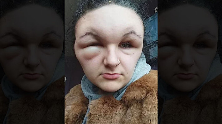 18 yaşındaki genç Georgina Paraskeva'nın yüzü, geçtiğimiz Kasım ayında saçını boyadıktan sonra iki katına kadar şişti. 
