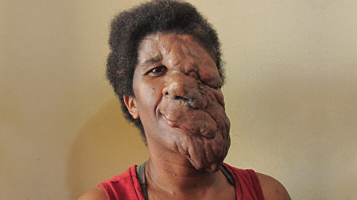 Aline Cerqueria Letie, Brezilya’da yaşıyor. Yüzünün sol tarafında büyük bir tümörle yaşayan kadın, üç yaşından beri bu hastalıkla mücadele ediyor. 