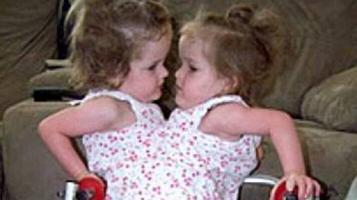 Kendra ve Maliyah Herrin, ABD’de 2002 yılında dünyaya gelen bitişik ikizler.