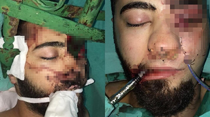 Alanya ilçesinde, 1 Ocak gecesi meydana gelen trafik kazasında 21 yaşındaki Emre Gündoğan'ın yüzüne bariyerin demir çubuğu saplandı. 