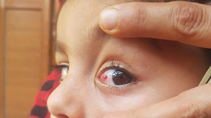 Göz Hastalıkları Uzmanı Doç. Dr. Cüneyt Karaarslan, halk arasında kırmızı göz hastalığı olarak adlandırılan konjonktivit hastalığına karşı uyarılarda bulundu.