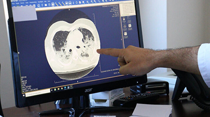 Ankara Sağlık Bilimleri Üniversitesi Gülhane Eğitim ve Araştırma Hastanesi Göğüs Hastalıkları Uzmanı Doç. Dr. Cantürk Taşçı, hastalara ait tomografi görüntüleri üzerinden Covid-19'un akciğerde yarattığı tahribatı anlattı. 