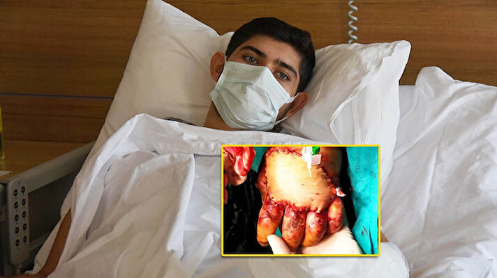 Hamza Fahri Özkan, geçen 17 Kasım'da çalıştığı matbaadaki ofset makinesine sol elini kaptırdı. Elinin üzeri parçalandı ve cilt dokusu ölerek kullanılmaz hale geldi.     