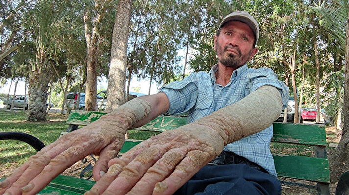 Antalya’nın Gazipaşa ilçesinde yaşayan 45 yaşındaki Musa Sümbül’ün hayatı 26 yıldır mücadele ettiği sedef hastalığı nedeniyle kabusa dönmüş durumda. 23 yıl önce bir sabah uyandığında derisinde kızarıklıklar olduğunu gören ve hastaneye giden Sümbül, kendisine verilen ilacı kullandı ancak derisindeki kızarıklıklar artmaya devam etti. Ellerinde, kollarında, ayaklarında, kulaklarında, yüzünde ve kafa derisinde oluşan kalın ve sert tabaka, Sümbül’ü çalışamaz hale getirdi.