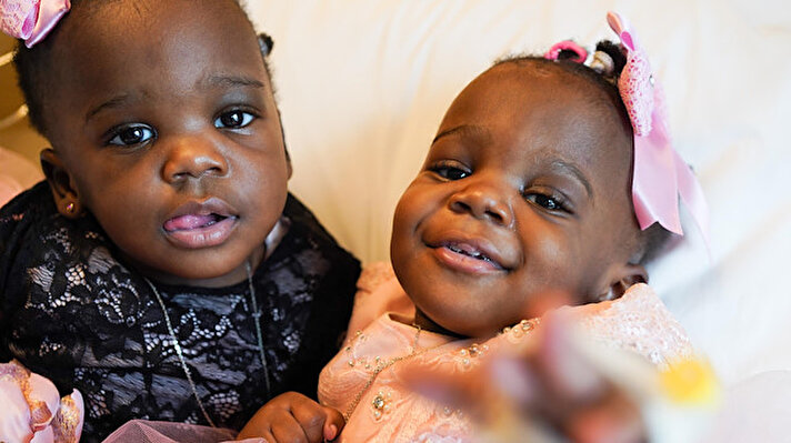 Kamerun'da geçen yıl Temmuz ayında dünyaya gelen Caroline ve Richard Akwe çiftinin siyam ikizleri Elizabeth ve Mary kalçalarından birbirine yapışıktı. 