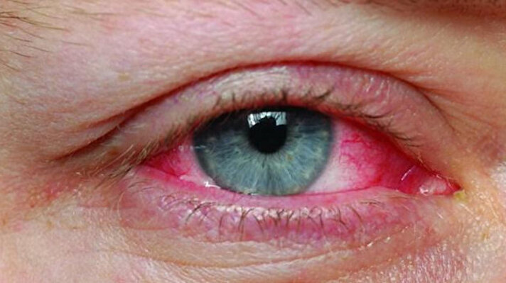 Halk arasında kırmızı göz hastalığı olarak da bilinen konjonktivit vakalarının sayısında son haftalarda yüksek bir artış olduğuna işaret eden Türk Oftalmoloji Derneği Oküler Enfeksiyon Birimi Başkanı Prof. Dr. Ulviye Yiğit, pandemi önlemlerinin gevşetilmesiyle beraber yeniden salgınlara dönüşen virüs enfeksiyonlarının gözleri de vurduğunu söyledi. Solunum yolu enfeksiyonlarına neden olmasıyla son günlerde oldukça gündemde olan adenovirüslerin, gözde de konjonktivite neden olan türleri olduğuna işaret eden Prof. Dr. Yiğit, bulaşıcılığının da çok yüksek olduğunu söyledi ve özellikle yakın temas, hijyene dikkat etmemek ve el göz teması ile hastalığın aile bireyleri arasında hızla yayılabildiğini, en çok da anaokulu gibi küçük yaş grubunda temasın engellenmesinin daha zor olması nedeniyle riskin daha yüksek olduğunu belirtti..