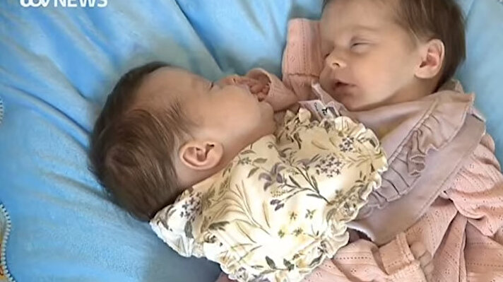 Annabelle ve Isabelle Bateson altı hafta önce Londra Üniversite Koleji Hastanesinde dünyaya geldiler.