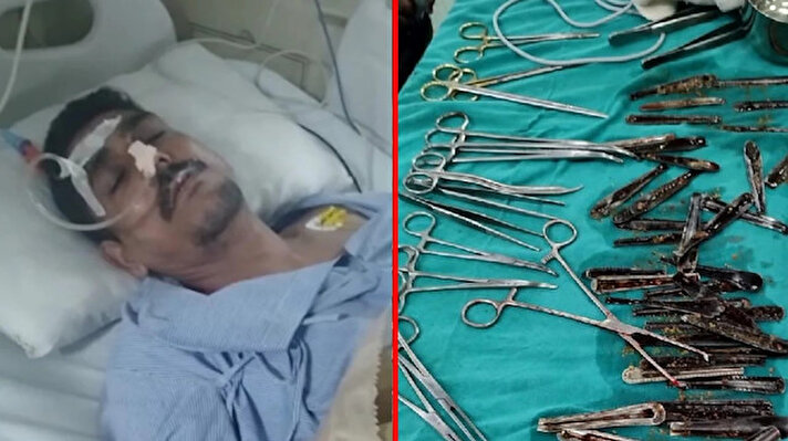 Hindistan'da karın ağrısı şikayetiyle hastaneye giden adamın midesinden 60'dan fazla metal kaşık çıkarıldı.