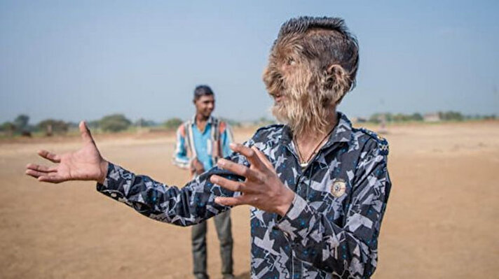 Hindistan'da, dünyada çok nadir görülen 'kurt adam sendromu' vakası görüldü.<br><br>
