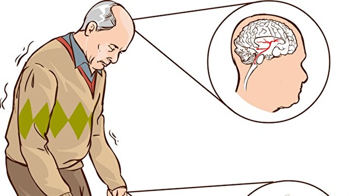 El Titremesi Parkinson Belirtisi Olabilir Mi