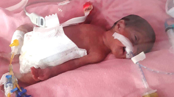 700 Gramken Kalp Ameliyati Olan Bebek Kurtuldu