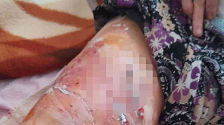 Antalyada Pitbullların saldırdığı kadın yaralandı: Gitti geldi yine ısırdı