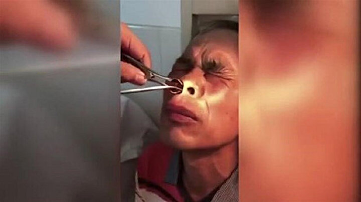 10 gün boyunca kanayan burnundan çıkanlar doktoru şoka uğrattı