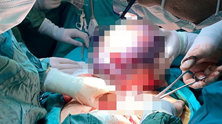 Nefes darlığı şikayetiyle gittiği hastanede karnından 10 kilo tümör çıkarıldı