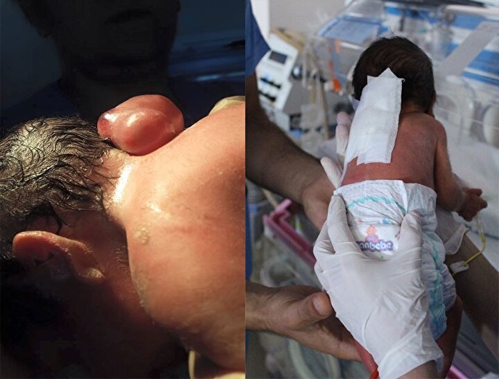 33 haftalik bebek boyle dogdu yeni safak