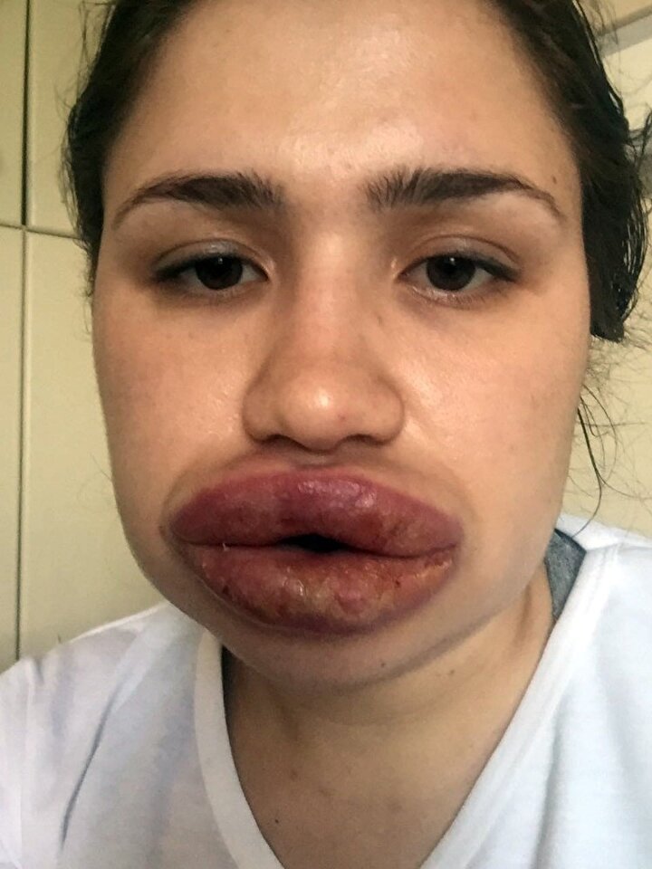 Silikon mağduru Merve hemşirenin son hali Yeni Şafak
