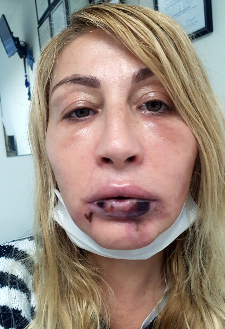 Antalya Haberleri Guzellik Ugruna Hayati Karardi Dudagini Kaybetti Agiz Ici Dokulari Curudu