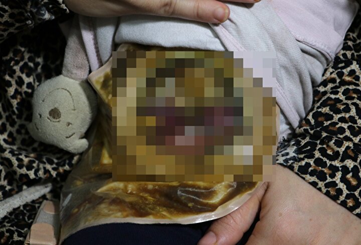 Minik Mariya bağırsağına takılan torbayla hayata tutunuyor 7 6c3c9fd7e82d46c690bb7130f9198499
