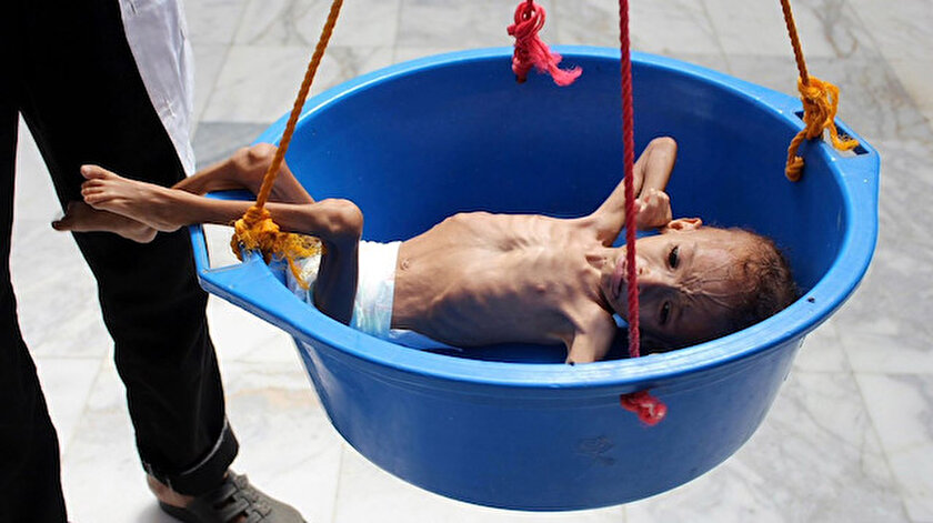 Yemende çocuklar bir deri bir kemik kalmış durumda