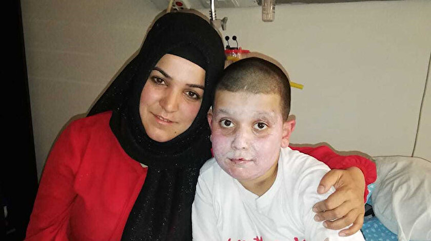 Atese Atilan Sprey Boya Cocugun Yuzunu Yakti Erzurum Yerel Haberleri
